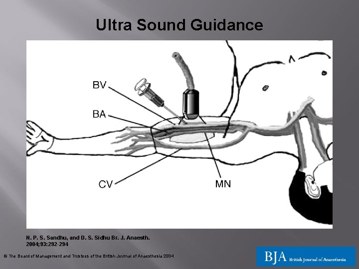 Ultra Sound Guidance N. P. S. Sandhu, and D. S. Sidhu Br. J. Anaesth. Ultra Sound Guidance N. P. S. Sandhu, and D. S. Sidhu Br. J. Anaesth.