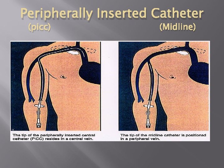 Peripherally Inserted Catheter (picc) (Midline) Peripherally Inserted Catheter (picc) (Midline)