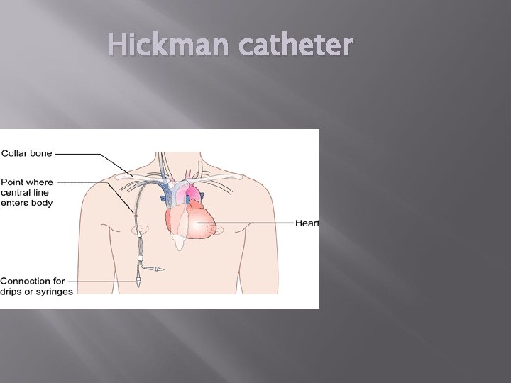 Hickman catheter 