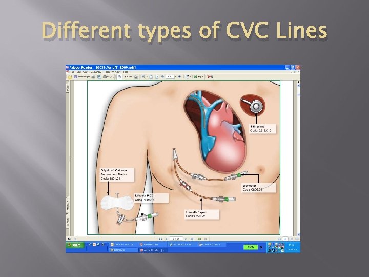 Different types of CVC Lines Different types of CVC Lines