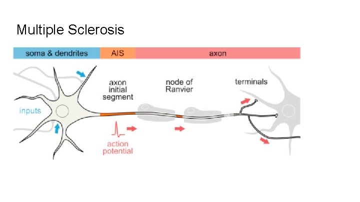 Multiple Sclerosis 