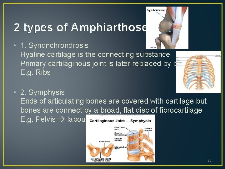 2 types of Amphiarthoses: • 1. Syndnchrondrosis Hyaline cartilage is the connecting substance Primary