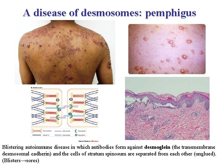 A disease of desmosomes: pemphigus Blistering autoimmune disease in which antibodies form against desmoglein