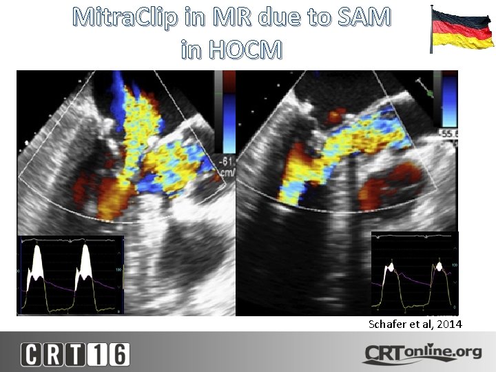 Mitra. Clip in MR due to SAM in HOCM Schafer et al, 2014 
