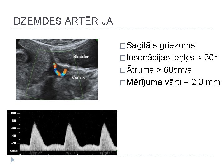 DZEMDES ARTĒRIJA �Sagitāls griezums �Insonācijas leņķis < 30° �Ātrums > 60 cm/s �Mērījuma vārti