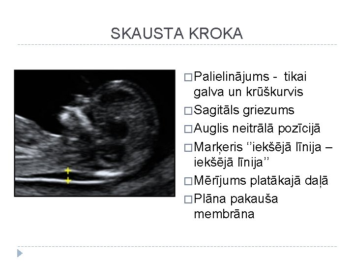 SKAUSTA KROKA � Palielinājums - tikai galva un krūškurvis � Sagitāls griezums � Auglis