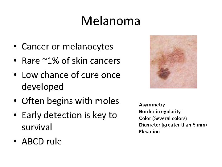 Melanoma • Cancer or melanocytes • Rare ~1% of skin cancers • Low chance Melanoma • Cancer or melanocytes • Rare ~1% of skin cancers • Low chance