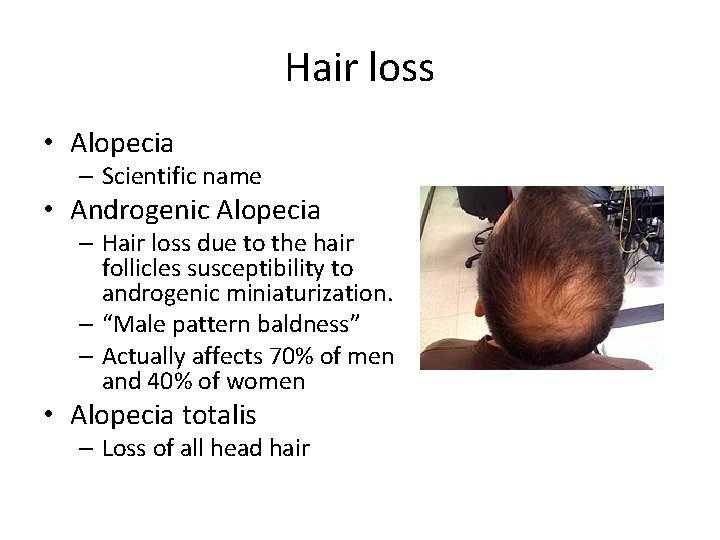 Hair loss • Alopecia – Scientific name • Androgenic Alopecia – Hair loss due Hair loss • Alopecia – Scientific name • Androgenic Alopecia – Hair loss due