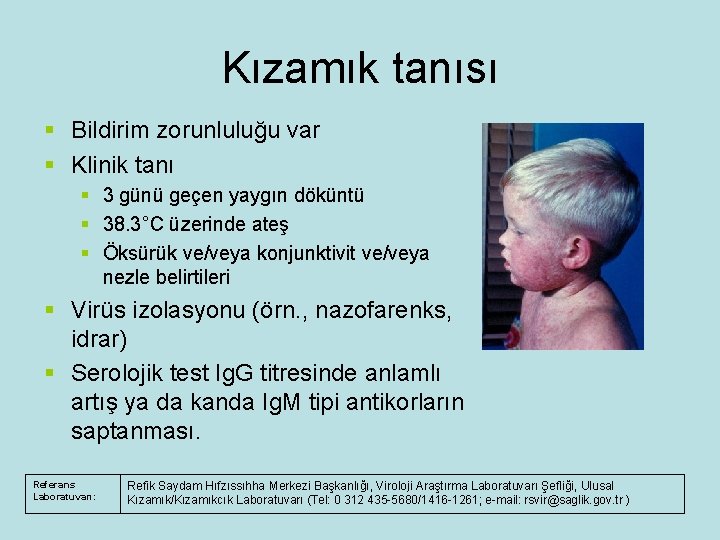 Kızamık tanısı § Bildirim zorunluluğu var § Klinik tanı § 3 günü geçen yaygın