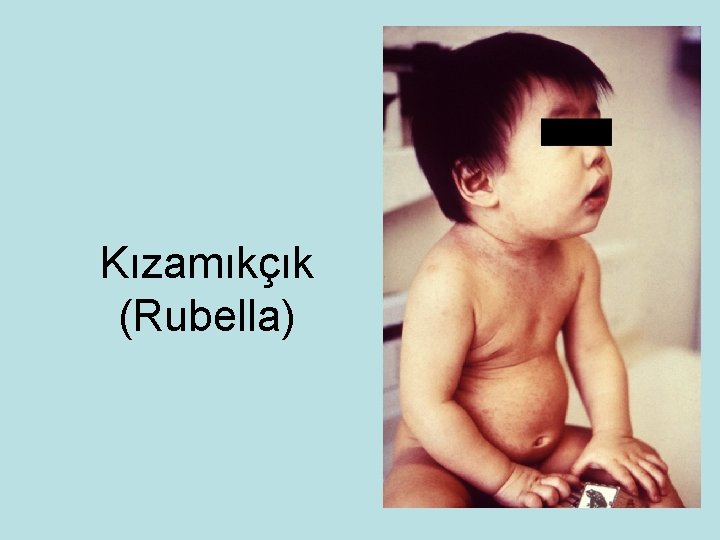 Kızamıkçık (Rubella) 