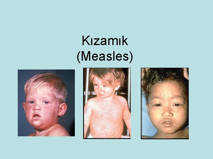 Kızamık (Measles) 