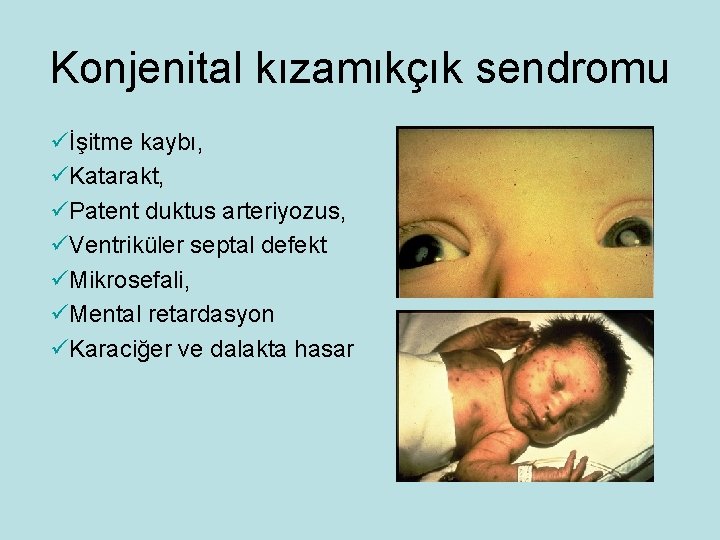 Konjenital kızamıkçık sendromu üİşitme kaybı, üKatarakt, üPatent duktus arteriyozus, üVentriküler septal defekt üMikrosefali, üMental