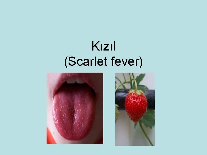 Kızıl (Scarlet fever) 