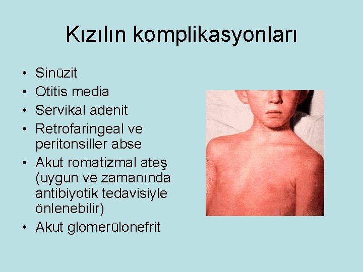 Kızılın komplikasyonları • • Sinüzit Otitis media Servikal adenit Retrofaringeal ve peritonsiller abse •