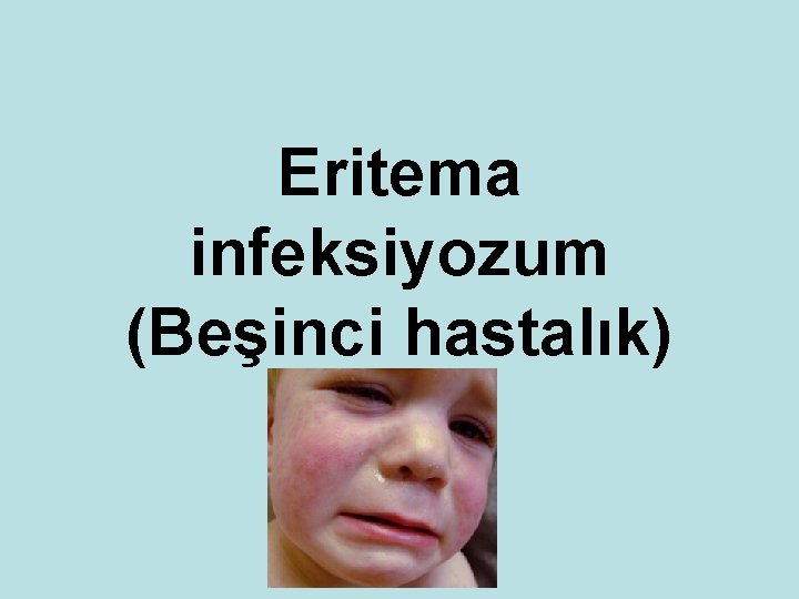 Eritema infeksiyozum (Beşinci hastalık) 