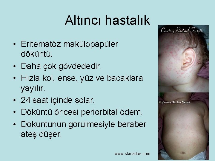 Altıncı hastalık • Eritematöz makülopapüler döküntü. • Daha çok gövdededir. • Hızla kol, ense,