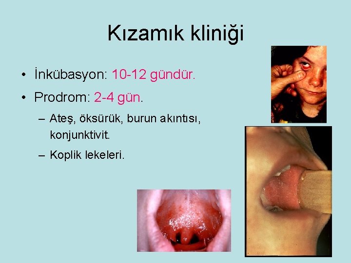 Kızamık kliniği • İnkübasyon: 10 -12 gündür. • Prodrom: 2 -4 gün. – Ateş,