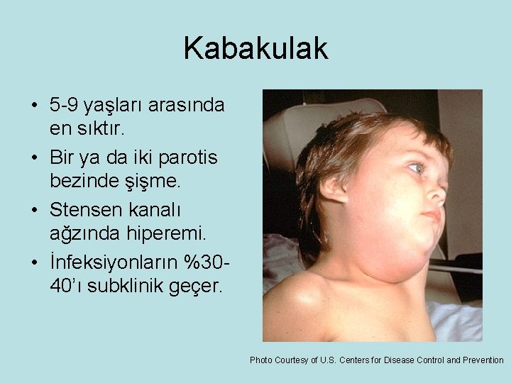 Kabakulak • 5 -9 yaşları arasında en sıktır. • Bir ya da iki parotis