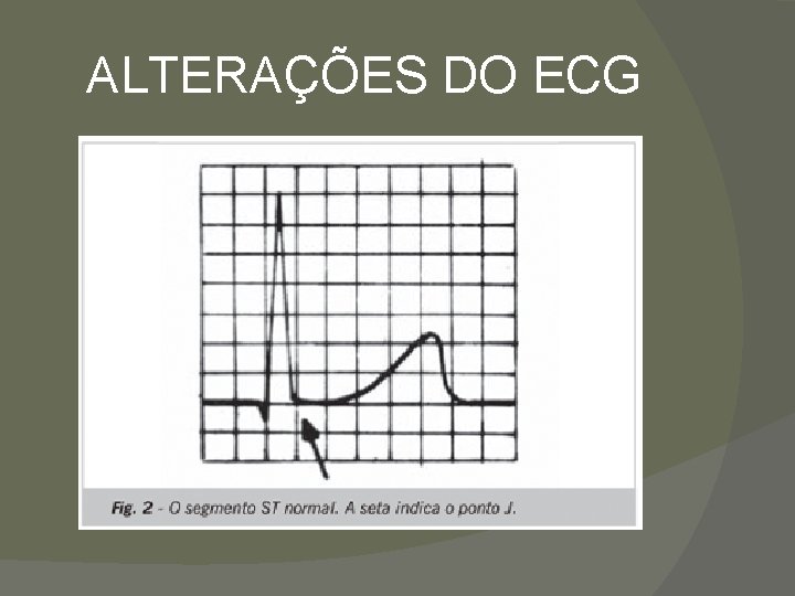 ALTERAÇÕES DO ECG 