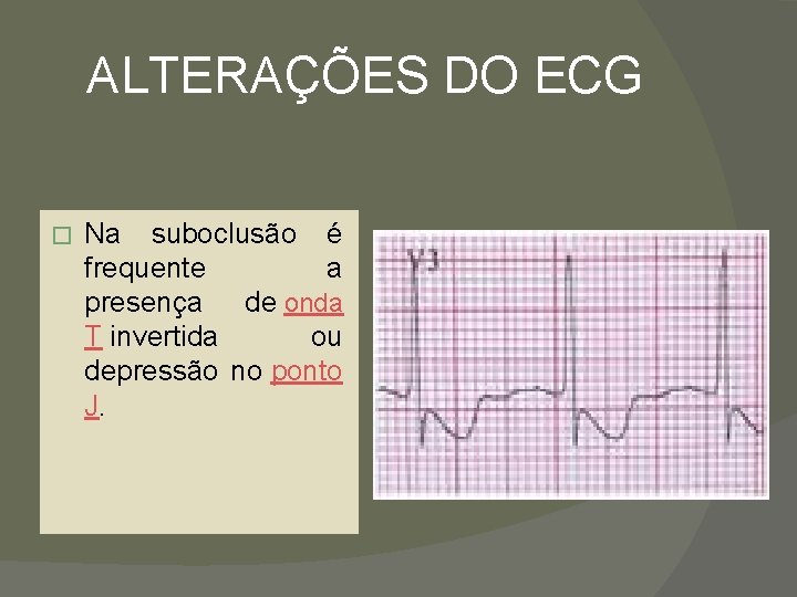 ALTERAÇÕES DO ECG � Na suboclusão é frequente a presença de onda T invertida