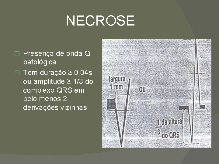 NECROSE Presença de onda Q patológica � Tem duração ≥ 0, 04 s ou