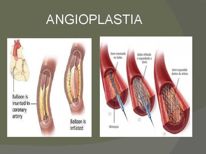 ANGIOPLASTIA 