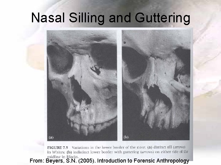 Nasal Silling and Guttering From: Beyers, S. N. (2005). Introduction to Forensic Anthropology 