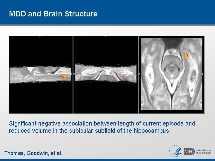 MDD and Brain Structure Significant negative association between length of current episode and reduced MDD and Brain Structure Significant negative association between length of current episode and reduced