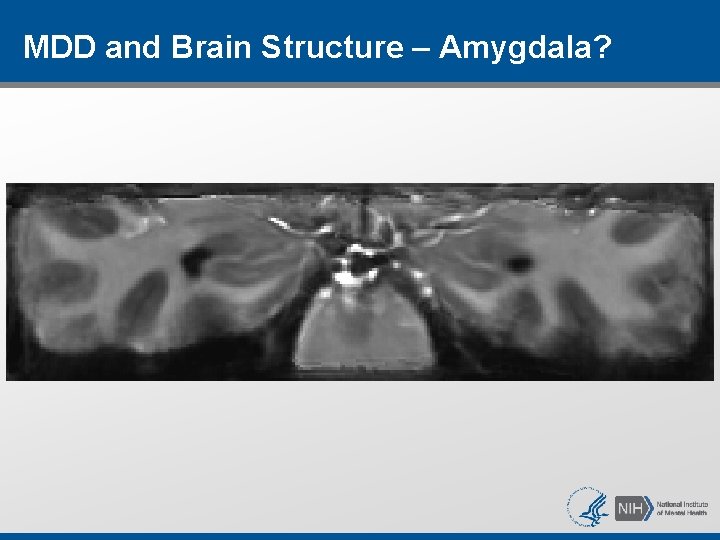MDD and Brain Structure – Amygdala? MDD and Brain Structure – Amygdala?