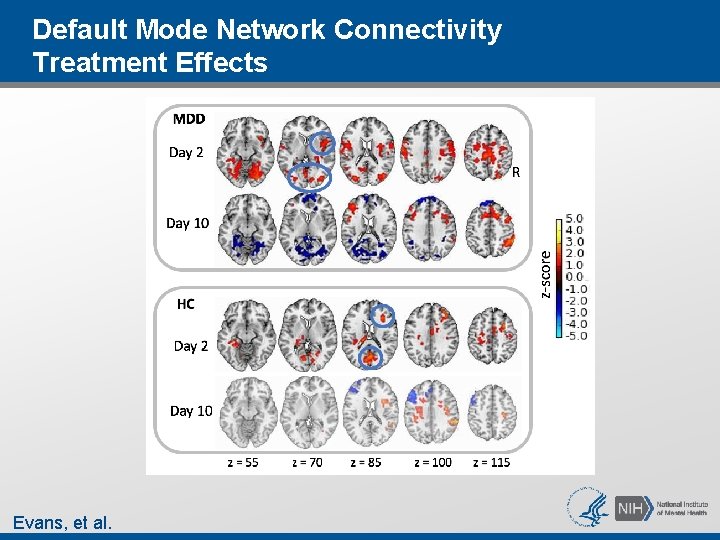 Default Mode Network Connectivity Treatment Effects Evans, et al. Default Mode Network Connectivity Treatment Effects Evans, et al.