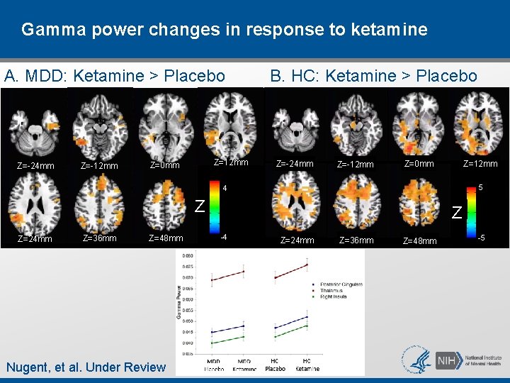 Gamma power changes in response to ketamine A. MDD: Ketamine > Placebo Z=-24 mm Gamma power changes in response to ketamine A. MDD: Ketamine > Placebo Z=-24 mm