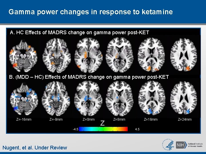 Gamma power changes in response to ketamine A. HC Effects of MADRS change on Gamma power changes in response to ketamine A. HC Effects of MADRS change on