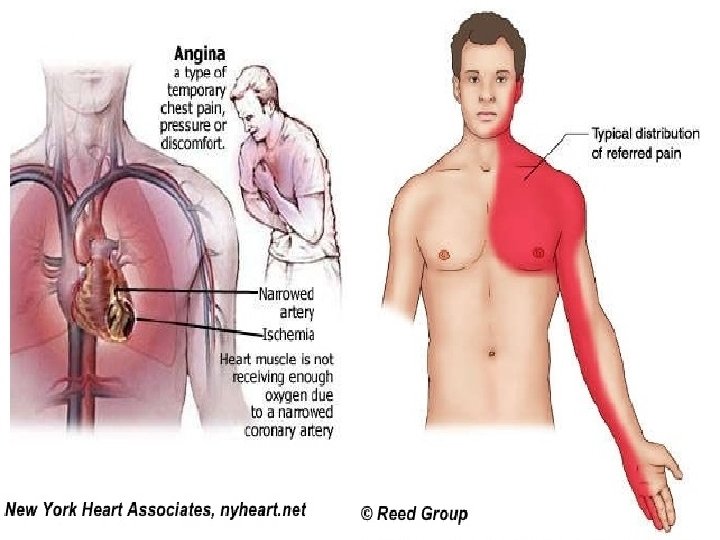 ANGINA AND MYOCARDIAL INFARCTION Angina pectoris is a