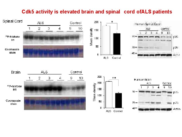 Cdk 5 activity is elevated brain and spinal cord of. ALS patients 