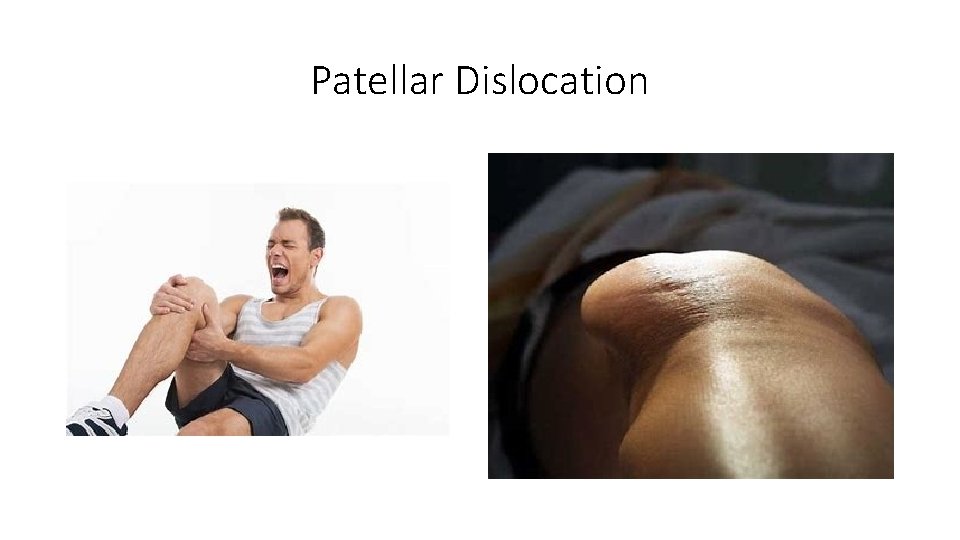 Patellar Dislocation 