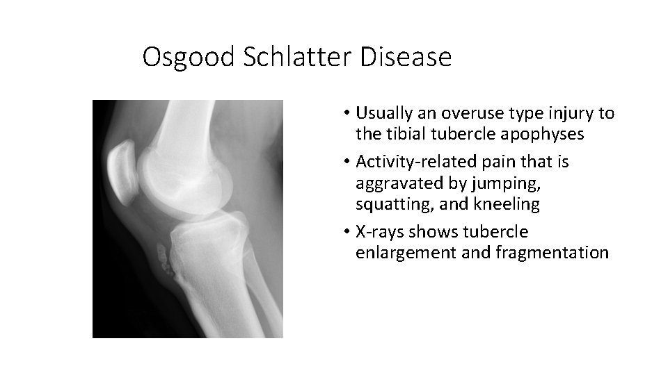 Osgood Schlatter Disease • Usually an overuse type injury to the tibial tubercle apophyses