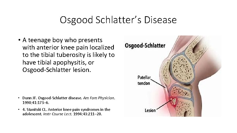 Osgood Schlatter’s Disease • A teenage boy who presents with anterior knee pain localized
