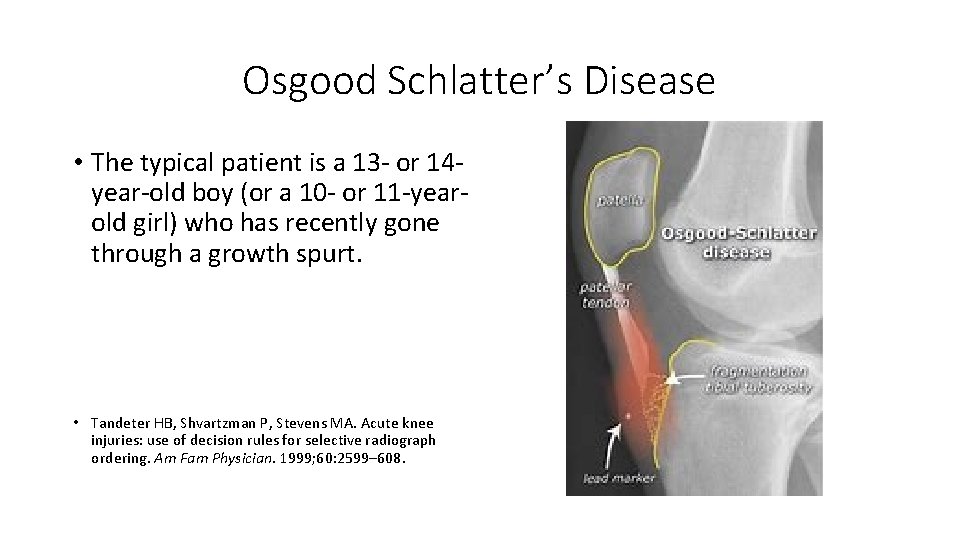 Osgood Schlatter’s Disease • The typical patient is a 13 - or 14 year-old