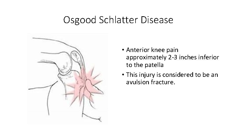 Osgood Schlatter Disease • Anterior knee pain approximately 2 -3 inches inferior to the