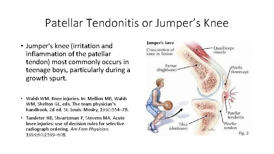 Patellar Tendonitis or Jumper’s Knee • Jumper's knee (irritation and inflammation of the patellar