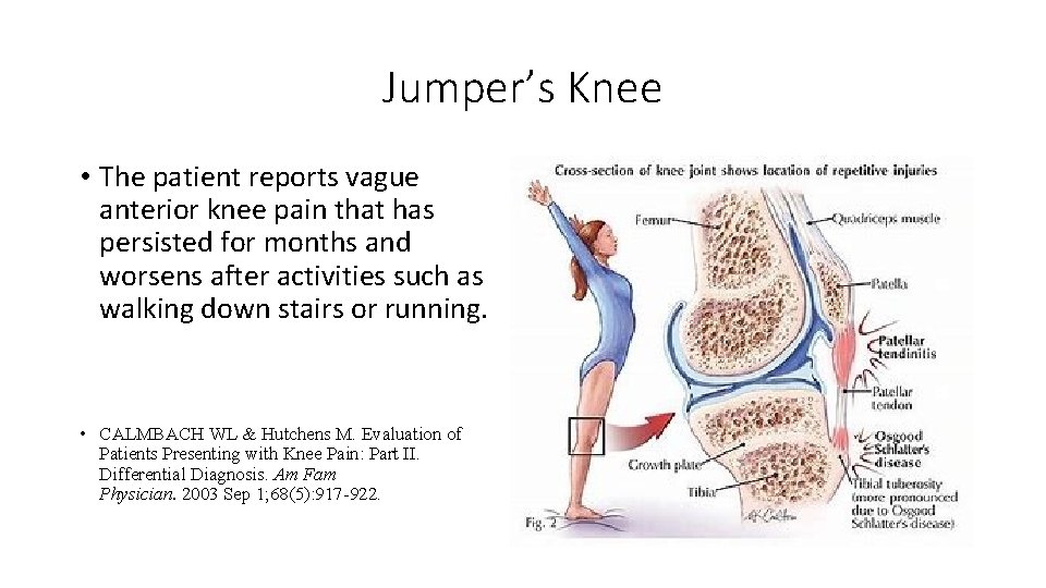 Jumper’s Knee • The patient reports vague anterior knee pain that has persisted for