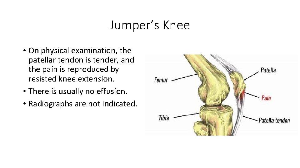 Jumper’s Knee • On physical examination, the patellar tendon is tender, and the pain