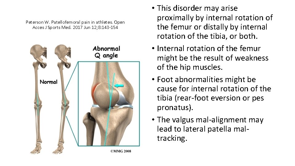 Peterson W. Patellofemoral pain in athletes. Open Acces J Sports Med. 2017 Jun 12;