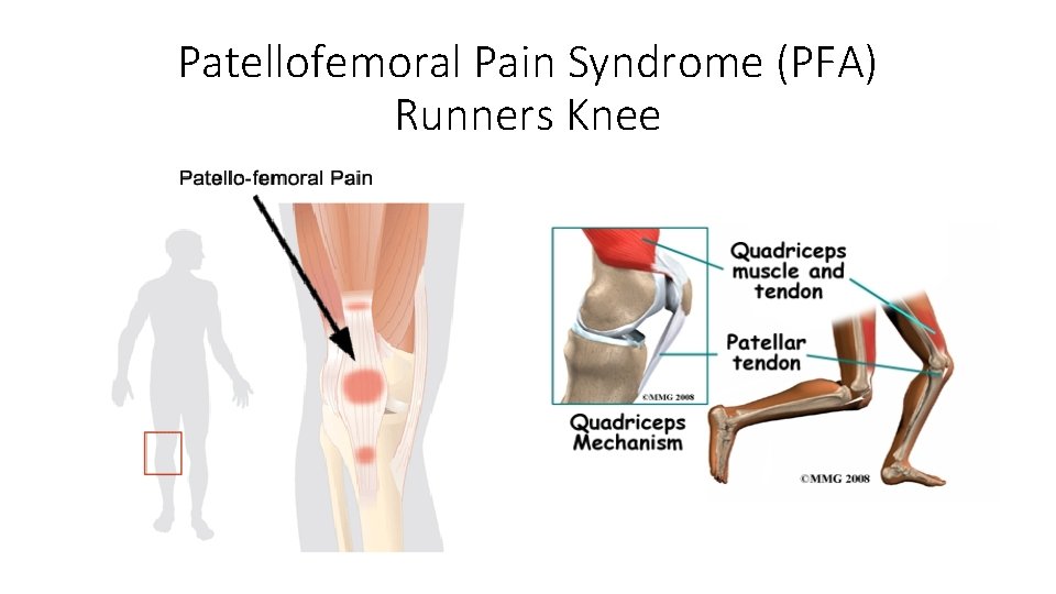 Patellofemoral Pain Syndrome (PFA) Runners Knee 