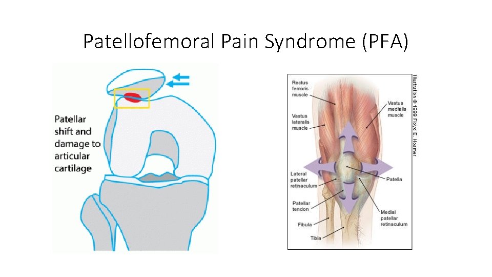 Patellofemoral Pain Syndrome (PFA) 