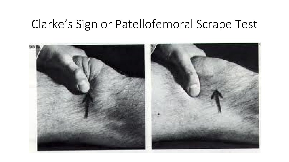 Clarke’s Sign or Patellofemoral Scrape Test 