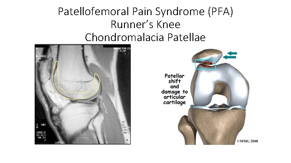 Patellofemoral Pain Syndrome (PFA) Runner’s Knee Chondromalacia Patellae 