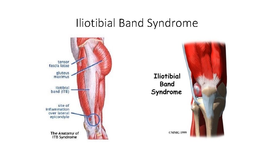 Iliotibial Band Syndrome 