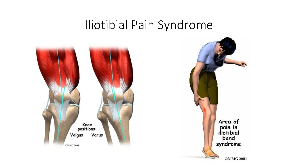 Iliotibial Pain Syndrome 