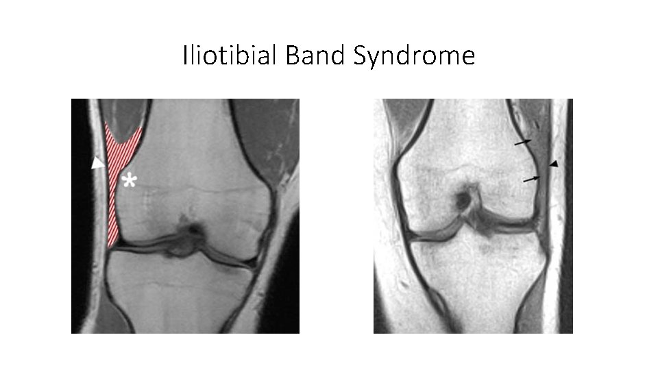 Iliotibial Band Syndrome 